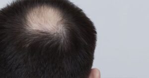 What Are the Reasons Behind Your Hair Loss?
