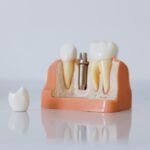 What Influences the Pricing of Dental Implants in the UK?