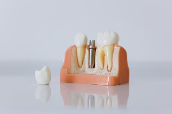 What Influences the Pricing of Dental Implants in the UK?