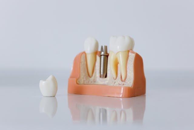 What Influences the Pricing of Dental Implants in the UK?